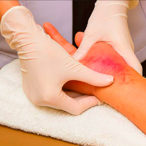 Manejo de Quemaduras